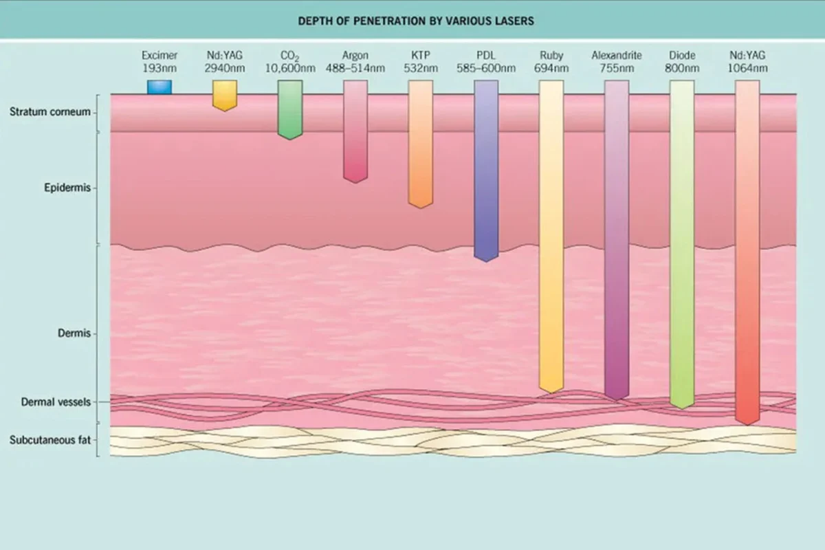 depth of laser penetration