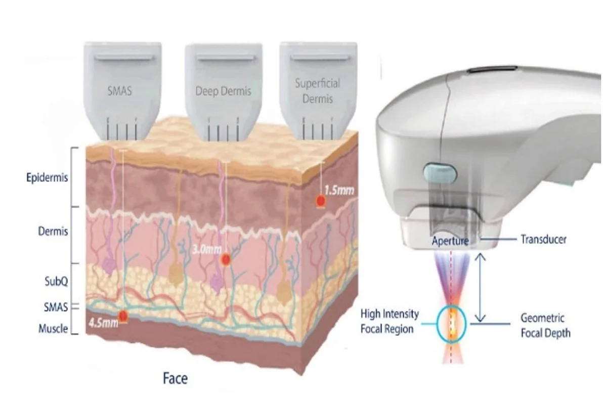 Hifu treatment