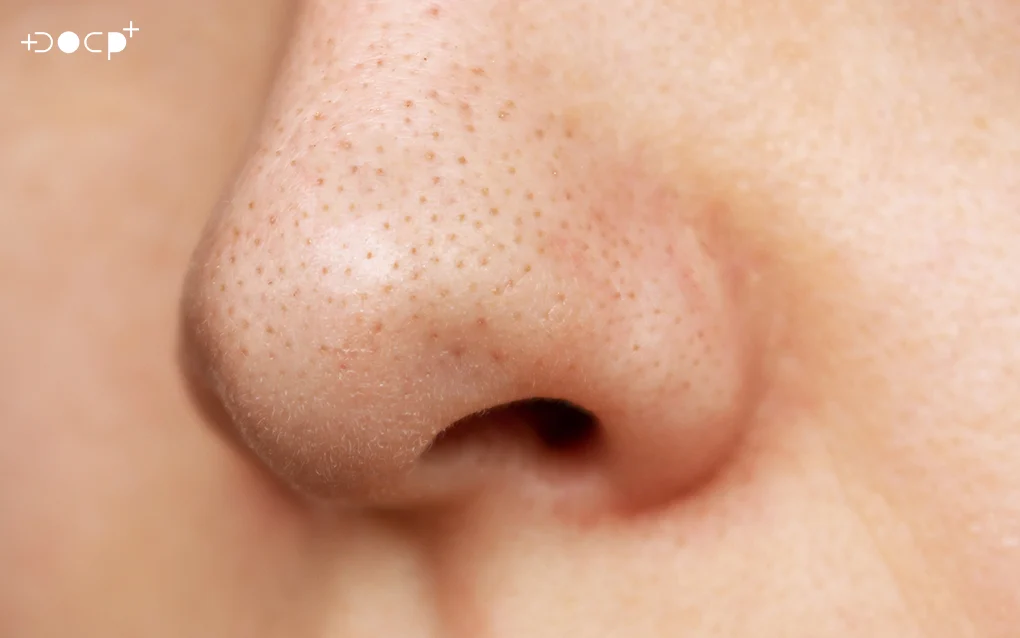 Nose-Job-Surgery-vs-Nose-Threadlift